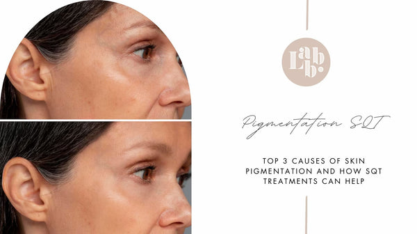 Causes of Skin Pigmentation & How SQT Treatments Help