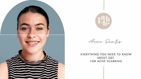 SQT for Acne Scarring - Everything You Need to Know